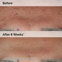 سرم ضد جوش Niacinamide 10% + Zinc 1% اوردینری حجم 60 میلی لیتر